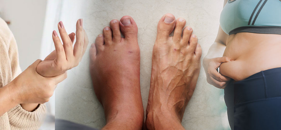 Water Retention: What Causes It and How to Get Rid of It Naturally